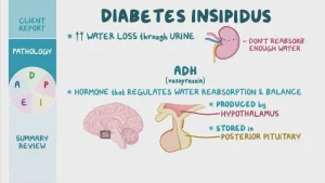 Understanding Nephrogenic Diabetes Insipidus