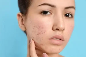 Quick Ways to Treat Acne and Scars
